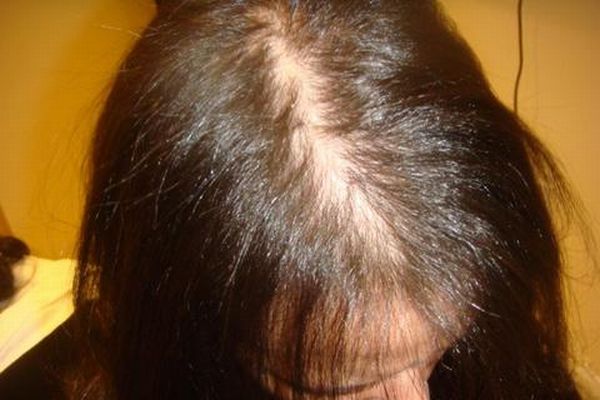 Female Pattern Baldness Diy Health Do It Yourself Health Guide By