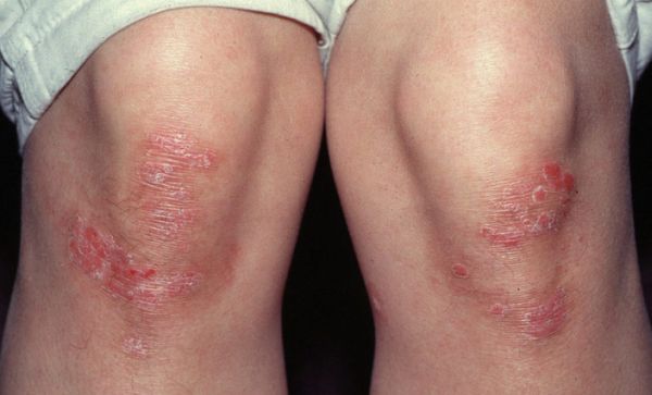 Psoriasis