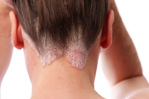 Scalp-Psoriasis