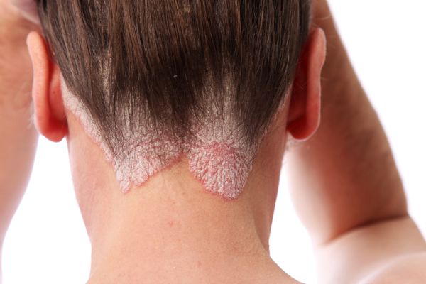 Scalp-Psoriasis