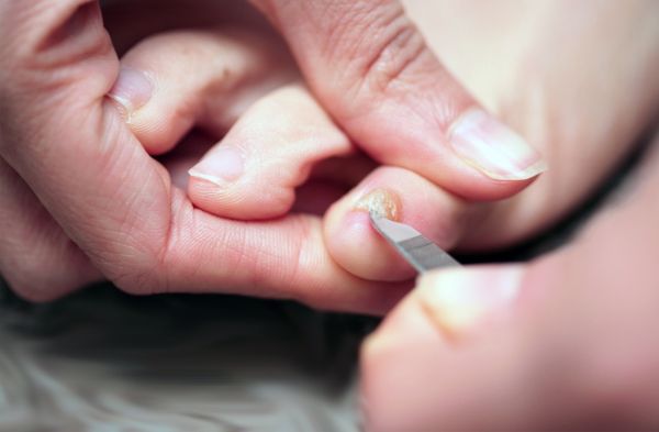 toenail-fungus-treatments
