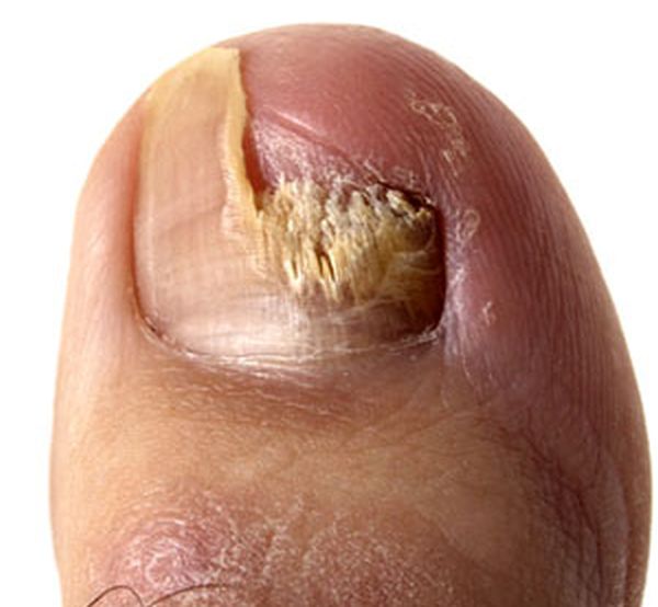 toenail_fungus_7