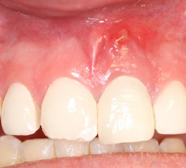 Gum and Tooth Abscess_1