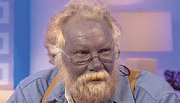 Argyria