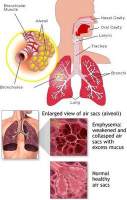 COPD patients