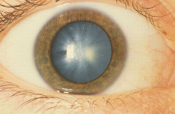 Diabetes and cataracts