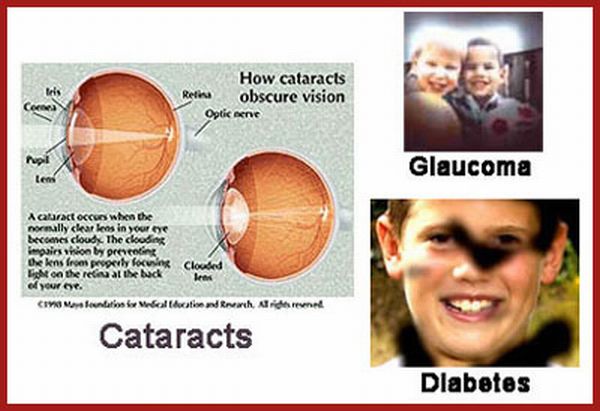 Diabetes and glaucoma