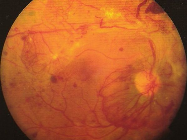 Diabetic retinopathy