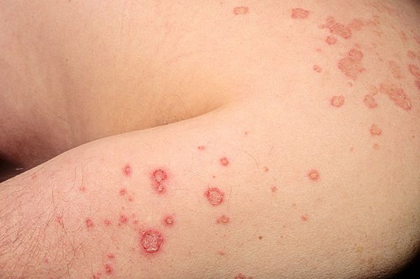 photos of severe eczema