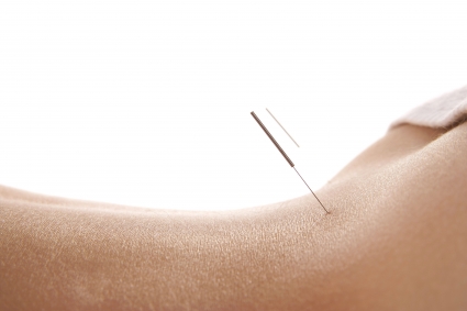 Lower back acupuncture