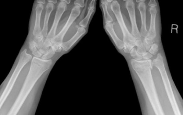 Osteoporosis in men