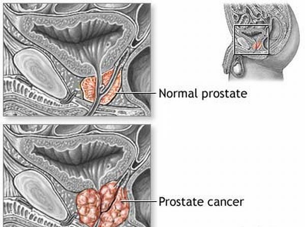 prostate cancer