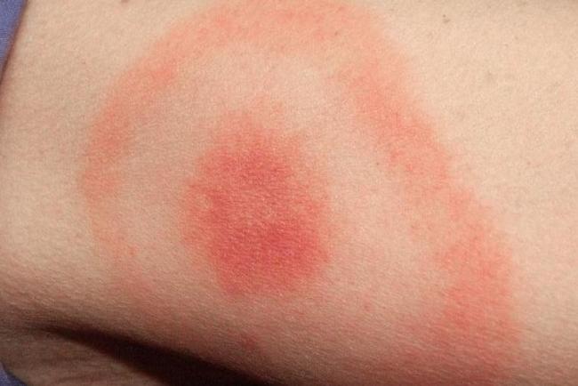 Lyme disease rash