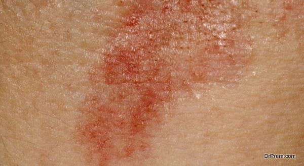 Rash Symptoms Treat Them Or Leave Them Alone Diy Health Do It