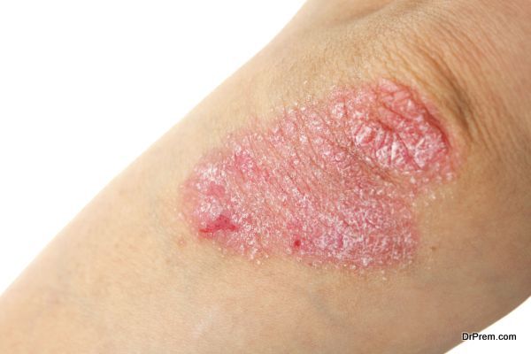 Psoriasis on elbows. Isolated on white