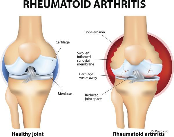 Arthritis 