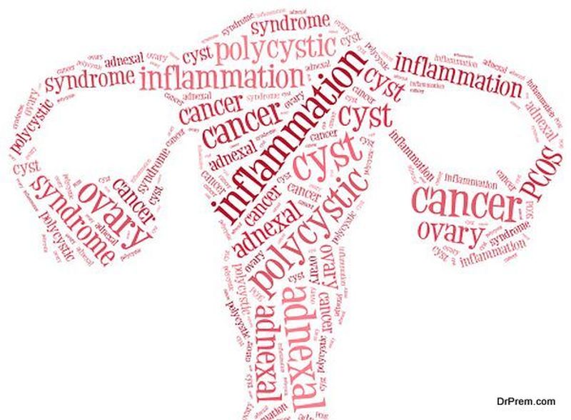 Word cloud illustration ovarian diseases related