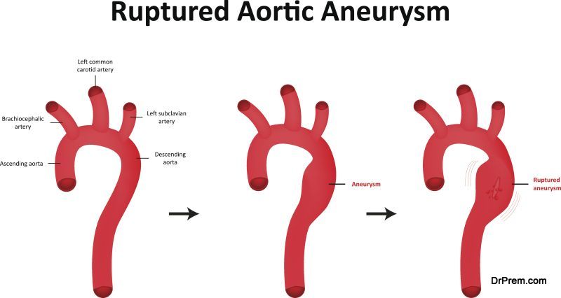 Ruptured Aortic Aneurysm Illustration