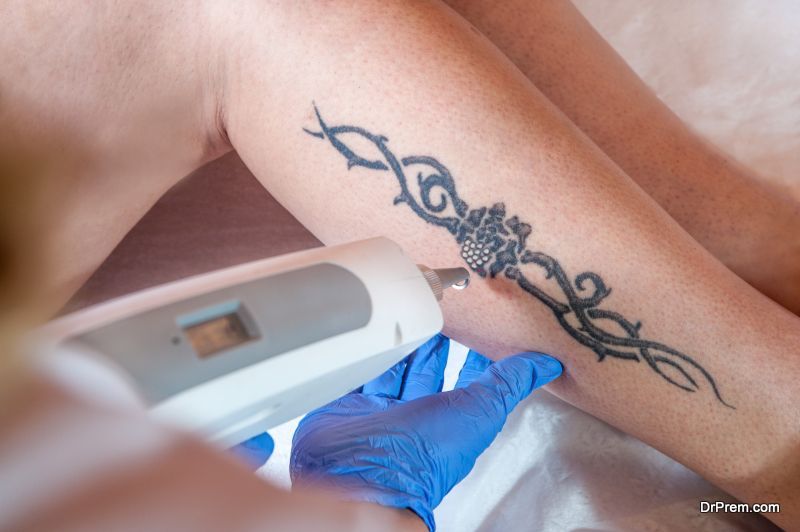 laser-tattoo-removal-processes