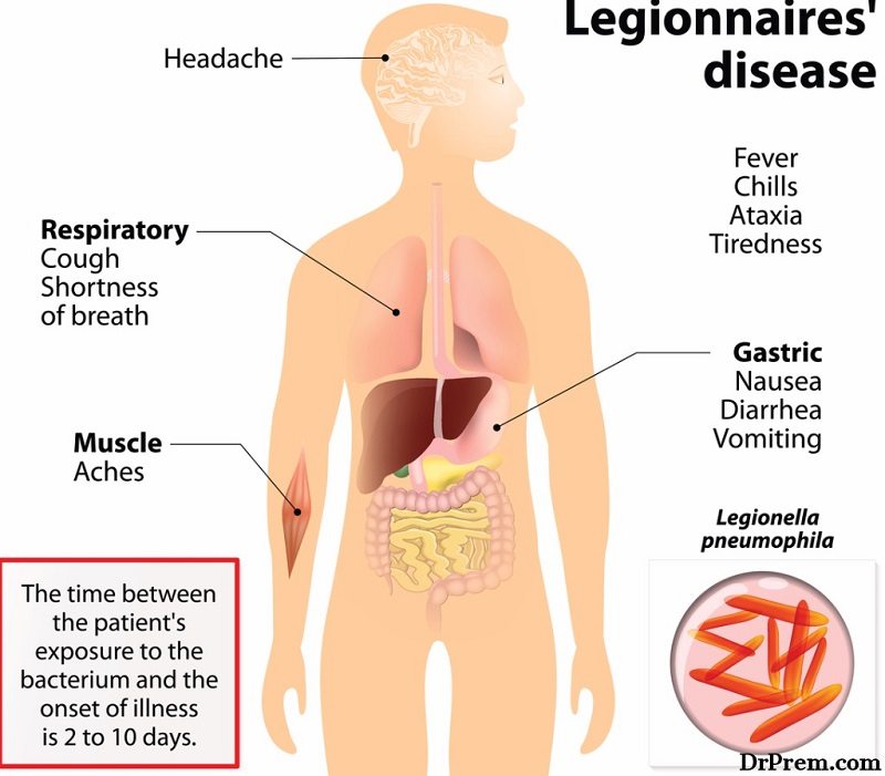 Legionnaires disease