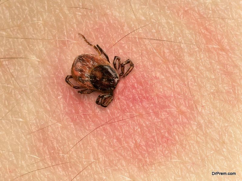 Lyme Disease