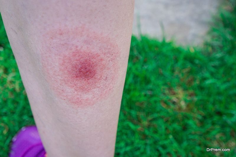 Lyme Disease