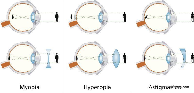 Myopia