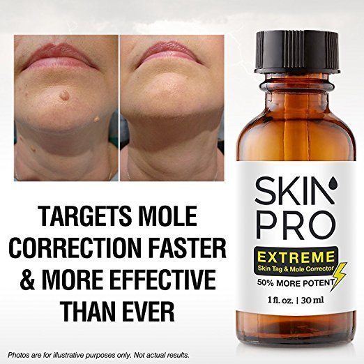 How To Get Rid Of Skin Tags - What Is It?