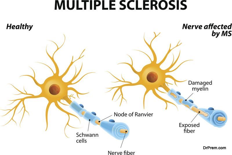 Multiple Sclerosis Awareness