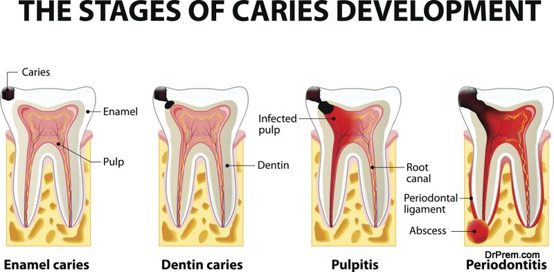 Dental-Abscesses