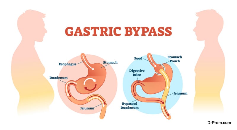 Gastric surgery for weight loss
