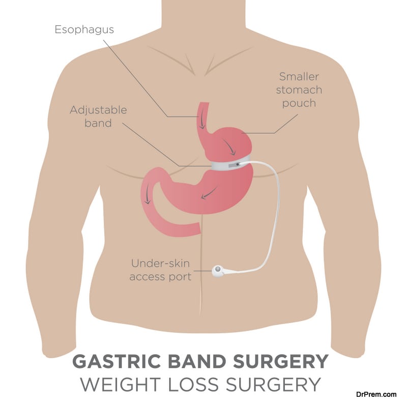 Gastric surgery for weight loss