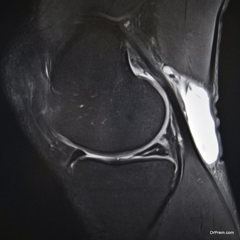 Meniscal-Tear.