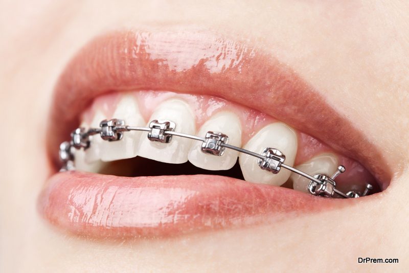 braces