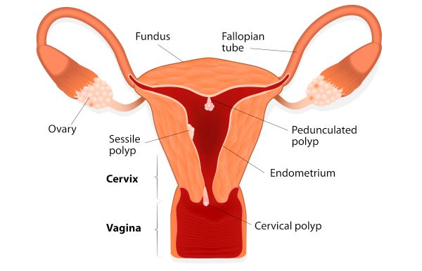  cervical-cancer