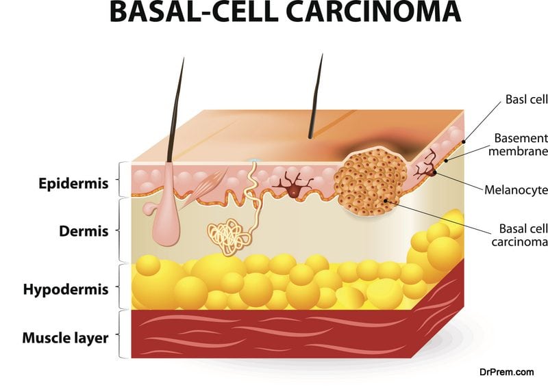  basal carcinoma