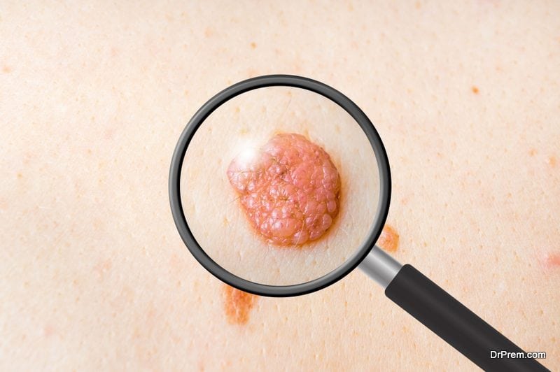 skin cancers