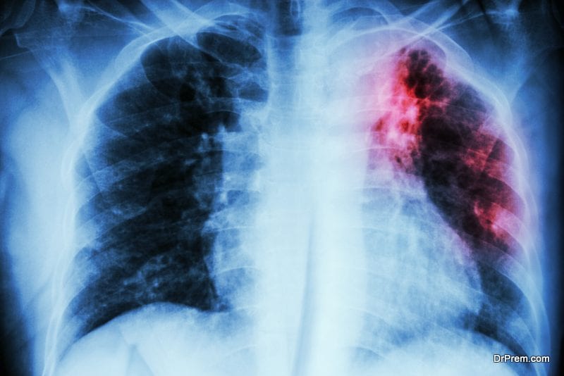 Treating drug resistant TB