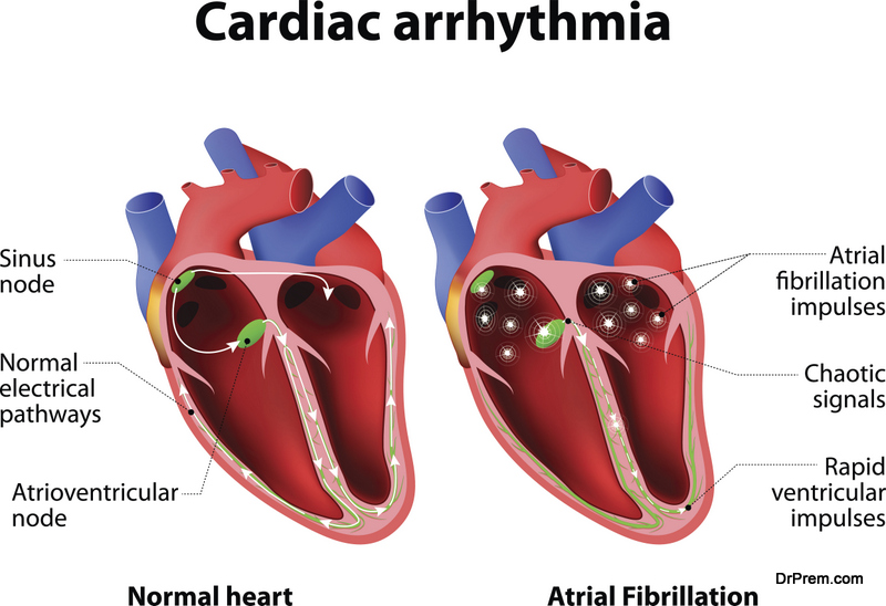 Cardiac-Arrhythmia