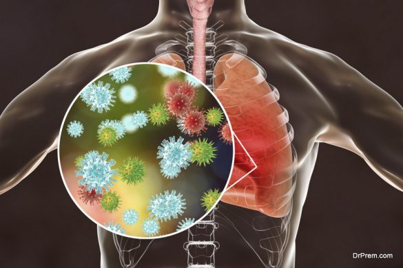 Mers-cove: Symptoms, diagnosis, and treatment