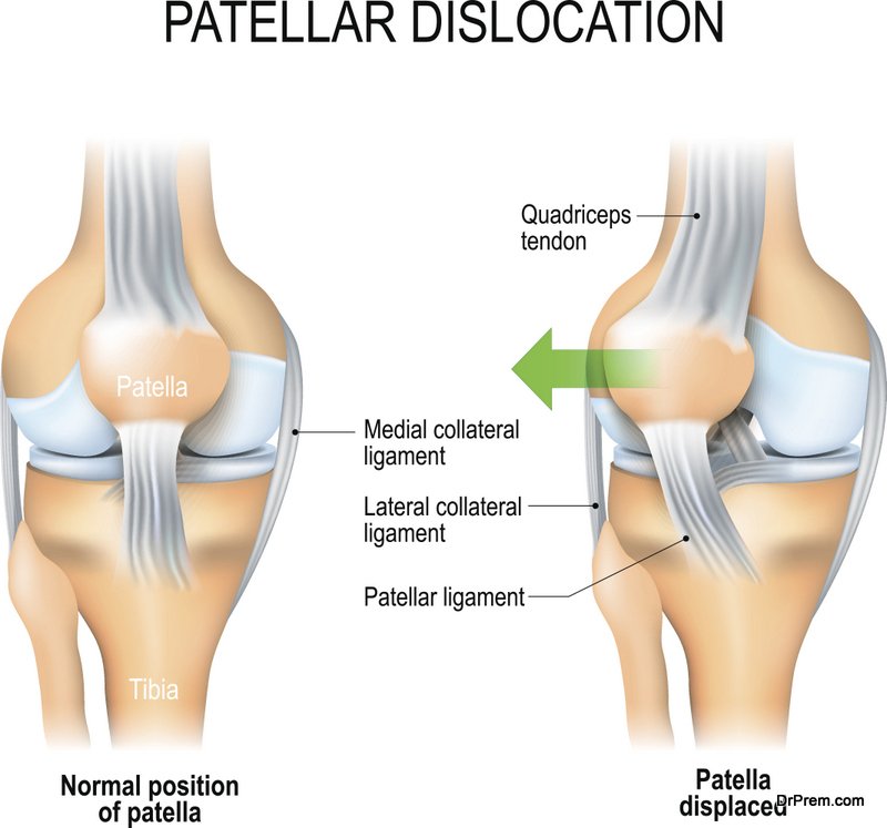 Anterior cruciate ligament