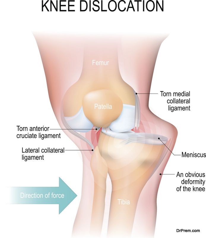 Anterior cruciate ligament