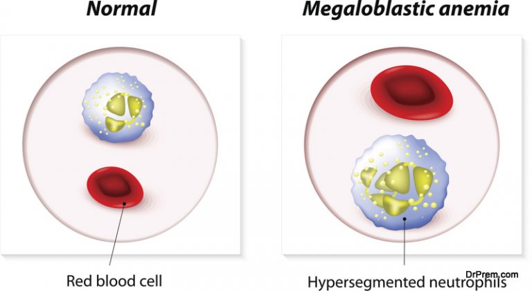 what-is-folate-deficiency-and-how-to-treat-it