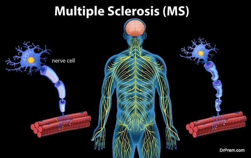 Human Anatomy of Multiple Sclerosis