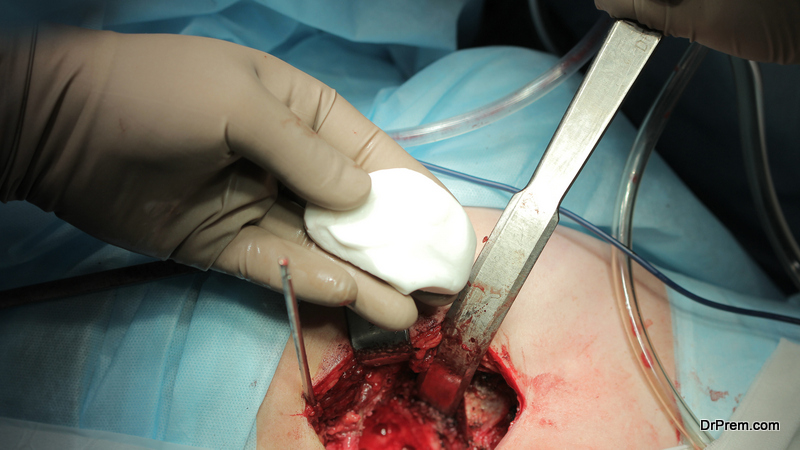Hip-Replacement-Surgery