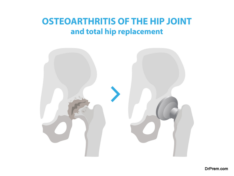 Hip-Replacement-Surgery