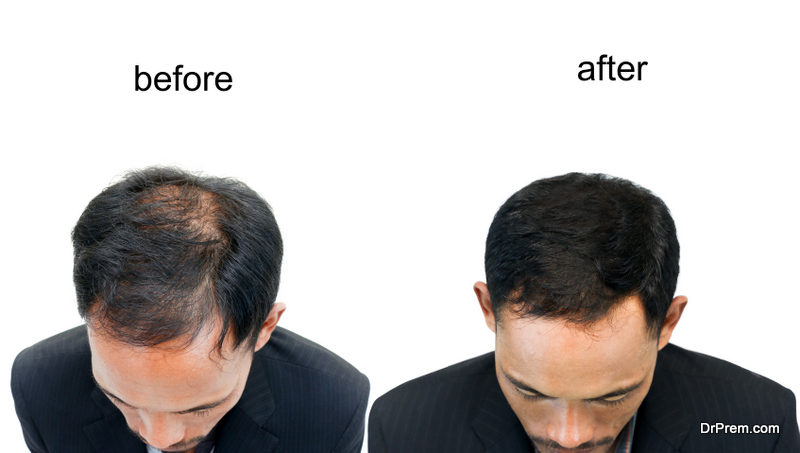 Hair loss