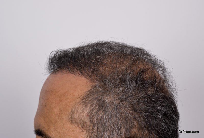 scalp-micro-pigmentation-