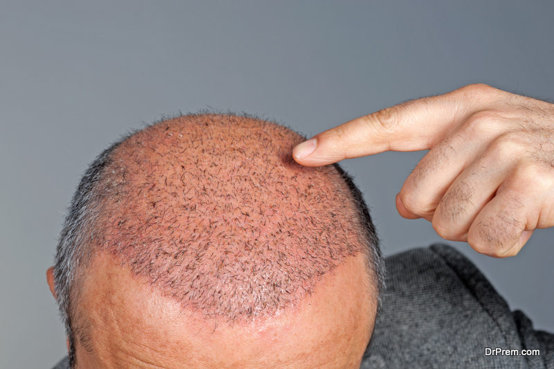 scalp-micro-pigmentation-