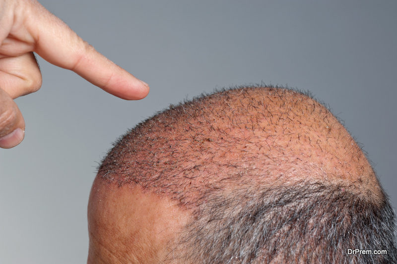 scalp-micro-pigmentation-